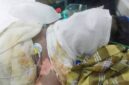 Aditya Wiranata (25), karyawan PT GBS asal Desa Panta Dewa, terbaring kritis dengan luka bakar 99 persen di ruang ICU RS Charitas Palembang akibat ledakan uap panas (steam) di area pabrik, Jumat (07/08/2026). (Foto: Dok/tintamerah.co)
