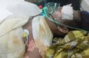 Aditya Wiranata (25), karyawan PT GBS asal Desa Panta Dewa, terbaring kritis dengan luka bakar 99 persen di ruang ICU RS Charitas Palembang akibat ledakan uap panas (steam) di area pabrik, Jumat (07/08/2026). (Foto: Dok/tintamerah.co)