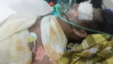 Aditya Wiranata (25), karyawan PT GBS asal Desa Panta Dewa, terbaring kritis dengan luka bakar 99 persen di ruang ICU RS Charitas Palembang akibat ledakan uap panas (steam) di area pabrik, Jumat (07/08/2026). (Foto: Dok/tintamerah.co)