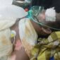 Aditya Wiranata (25), karyawan PT GBS asal Desa Panta Dewa, terbaring kritis dengan luka bakar 99 persen di ruang ICU RS Charitas Palembang akibat ledakan uap panas (steam) di area pabrik, Jumat (07/08/2026). (Foto: Dok/tintamerah.co)