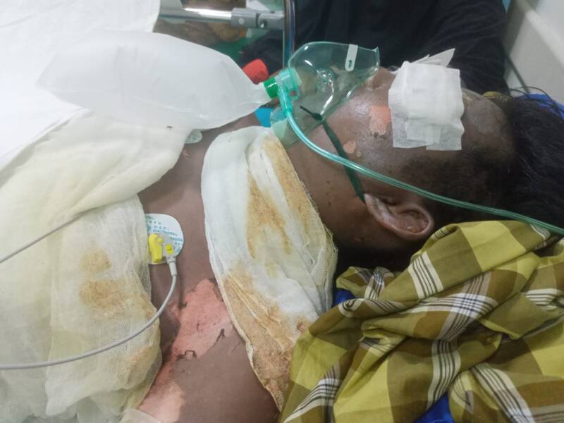 Aditya Wiranata (25), karyawan PT GBS asal Desa Panta Dewa, terbaring kritis dengan luka bakar 99 persen di ruang ICU RS Charitas Palembang akibat ledakan uap panas (steam) di area pabrik, Jumat (07/08/2026). (Foto: Dok/tintamerah.co)
